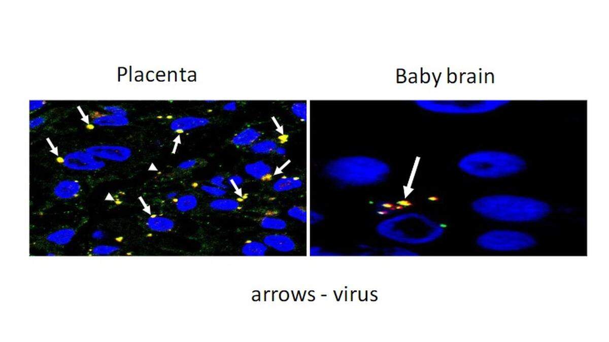 Researchers at the University of Miami Health System and the University of Miami Miller School of Medicine have shown that, in two cases, COVID-19 infection breached the placenta and caused brain damage in the newborn.