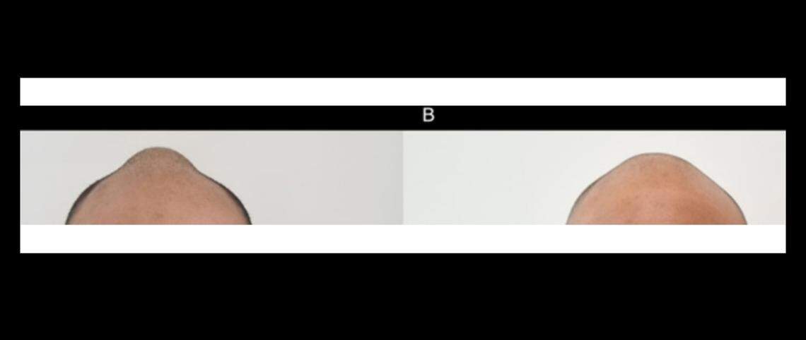 The lump grew for years as the man started balding, doctors said. Photos show before and after his corrective surgery.