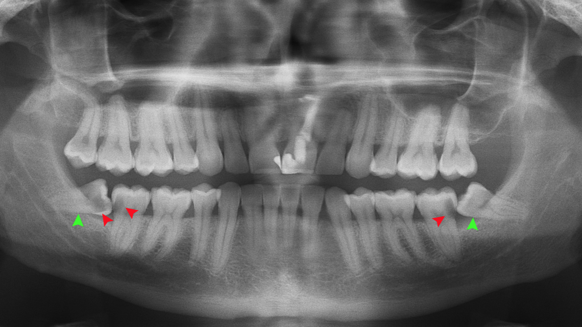 Those who were prescribed an opioid before or after their wisdom teeth removal are nearly 3 times as likely to go on to long-term use of the drug, according to a University of Michigan study published in the journal JAMA.