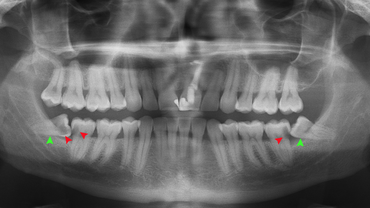 Those who were prescribed an opioid before or after their wisdom teeth removal are nearly 3 times as likely to go on to long-term use of the drug, according to a University of Michigan study published in the journal JAMA.