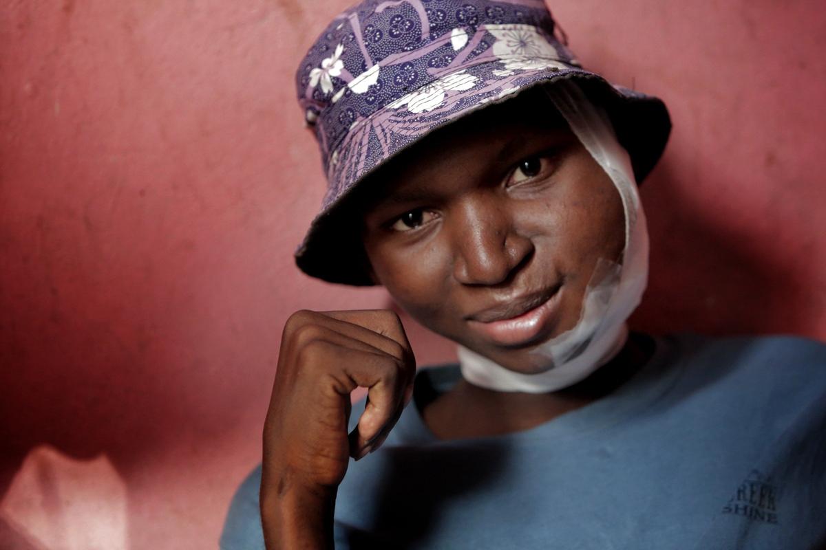 Djooly Jeune had chemotherapy for Burkitt lymphoma at the University Hospital of Mirebalais, in central Haiti.