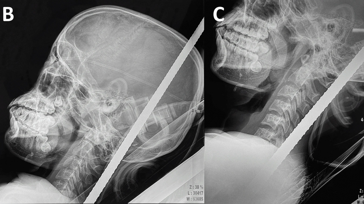 An 18-year-old construction worker was impaled with an iron rod after falling from scaffolding in Vietnam.
