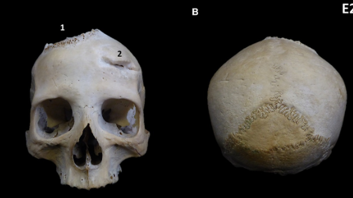 Ancient Egyptians suffering from cancer may have been subject to exploratory or treatment surgeries, a new study says.