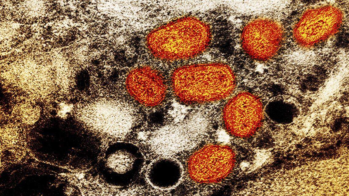 Officials declared the spread of monkeypox a public health emergency in the U.S. There are over 7,000 cases as of Aug. 4 as vaccines are getting distributed.