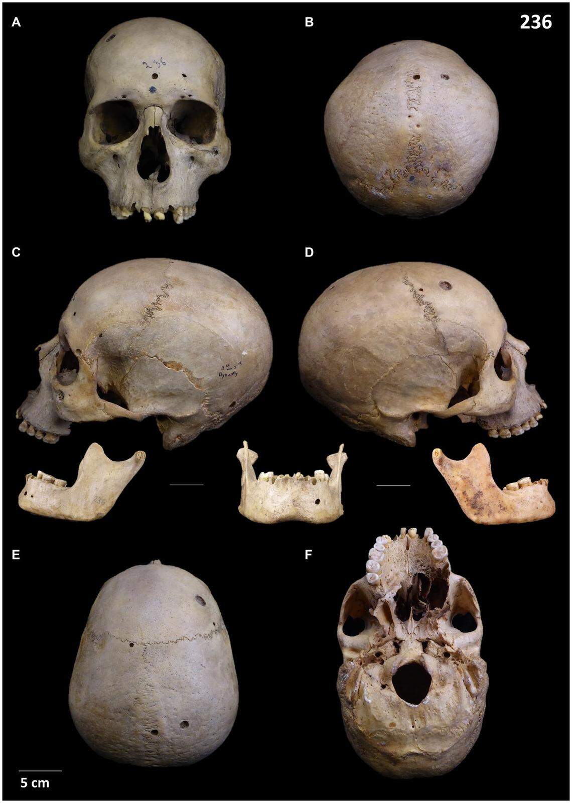 The skull of a middle-aged woman was found to have multiple lesions, some caused by injury and one from cancer, according to the study.