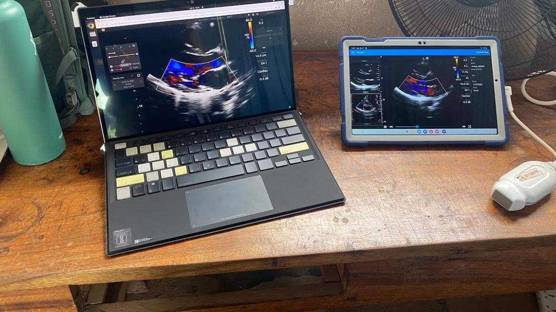 A handheld echo device and ultrasound probe, right, sit next to the portable AI device developed by Children’s National and Us2.ai during its initial testing phase in northern Uganda.