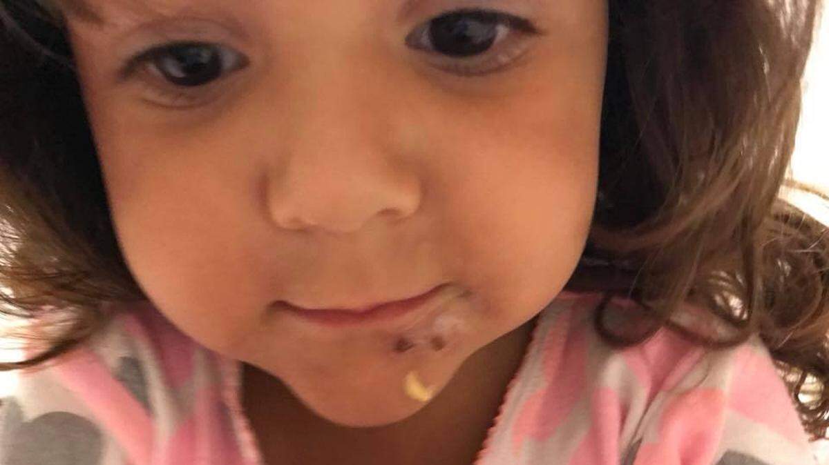 Three-year-old Aaliyah Casola was hospitalized after catching two bacterial infections at Crandon Park in Key Biscayne, her mom says.