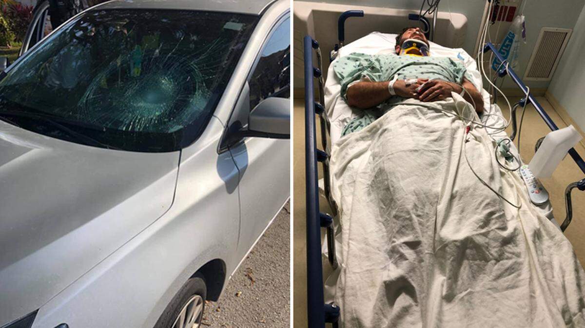 South Florida lawyer James DeMiles was hospitalized on Friday, Oct. 18, 2019, after he was running on the side of a road and hit by a driver in Hollywood. His head hit the driver’s side window.