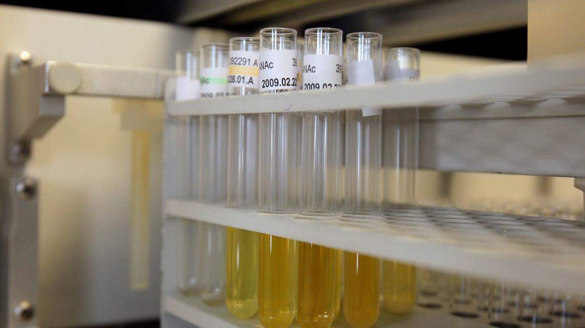 A urine test developed by Nagoya University researchers in Japan can detect brain tumors in people with 100% sensitivity and 97% specificity, which could help early detection of brain cancer, leading to improvements in patient survival.