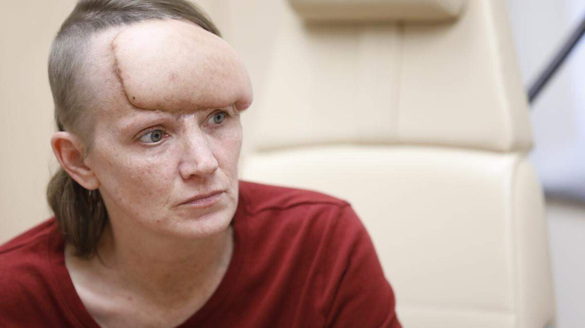 April Adcox no tenía seguro cuando le diagnosticaron cáncer de piel en 2020. Retrasó el tratamiento durante 18 meses porque estaba aterrorizada por la compleja cirugía y la perspectiva de una factura elevada. Mientras tanto, usó sombreros y flequillo para camuflar el área afectada a medida que se expandía en su frente. (Andrew J. Whitaker para KHN)