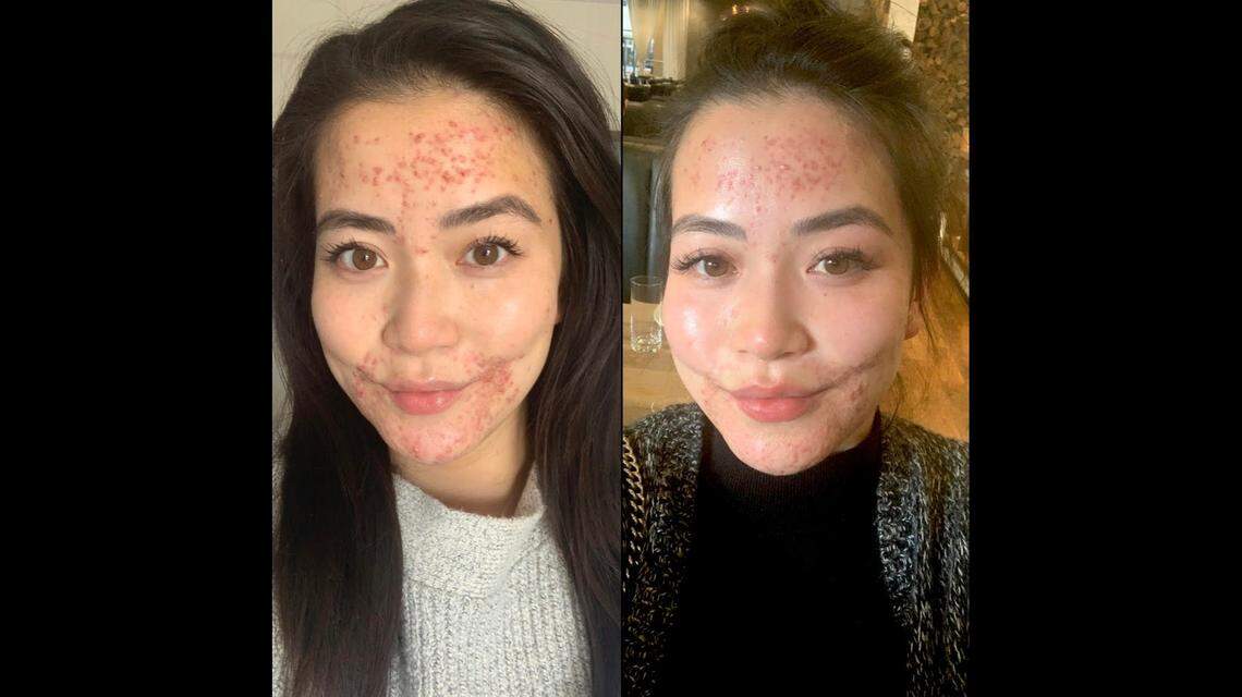 Frances Wang shared a before and after photo on her Instagram Monday of how her face has improved since she took time off to heal from perioral dermatitis.
