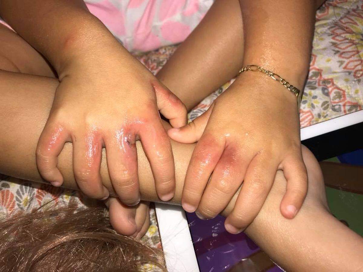 Three-year-old Aaliyah Casola was hospitalized after catching two bacterial infections at Crandon Park in Key Biscayne, her mom says.