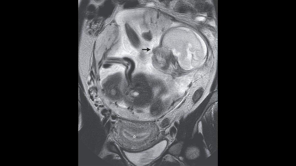 An MRI was taken of the woman’s abdomen and showed her uterus, marked by the asterisk, empty, and the fetus, marked by the black arrow, growing above, doctors said.
