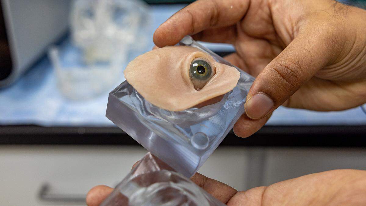 Vasudev Vivekanand Nayak, the 3D-bioprinting facility's operational manager, demonstrates an orbital exenteration prosthesis — a custom artificial eye and surrounding facial prosthesis — created for patients who have lost an eye made from a 3D-printed mold at the 3D Bioprinting Facility at the University of Miami Miller School of Medicine in Miami on Tuesday, June 2, 2026.