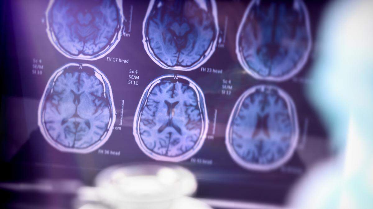 Researchers are recruiting patients for a new study involving Leqembi, the new drug the FDA recently approved for treating Alzheimer’s.