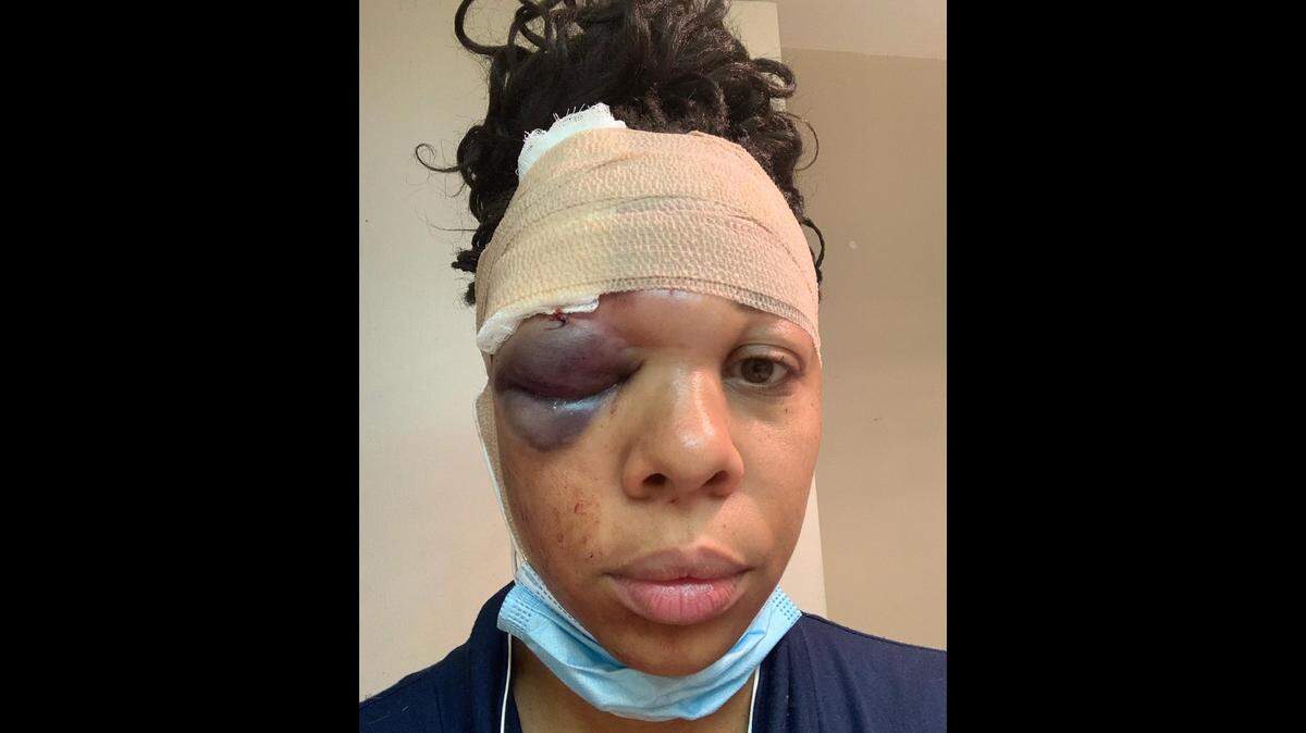 Latoya Ratlieff tras recibir el impacto de una bala de goma en el ojo.