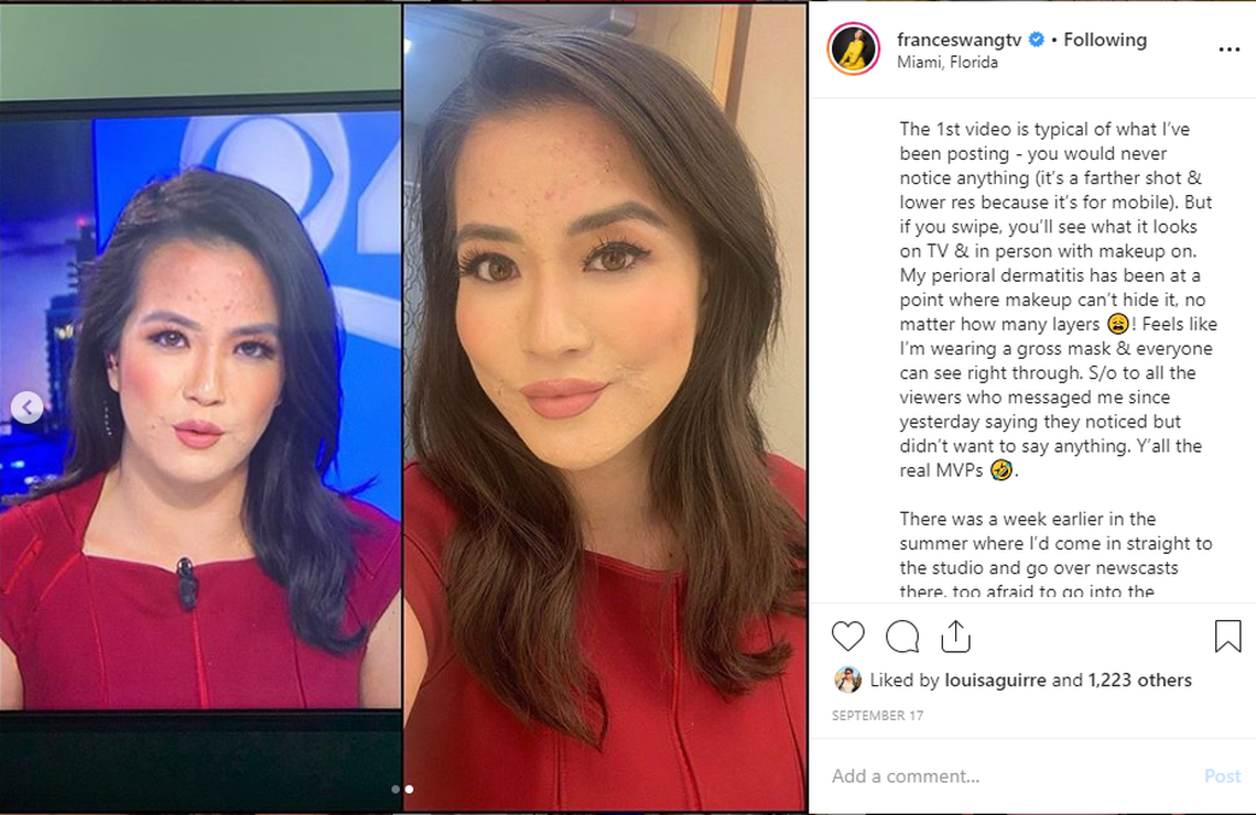 Frances Wang struggled to hide the skin condition from her TV audience. At one point, not even makeup could hide it.