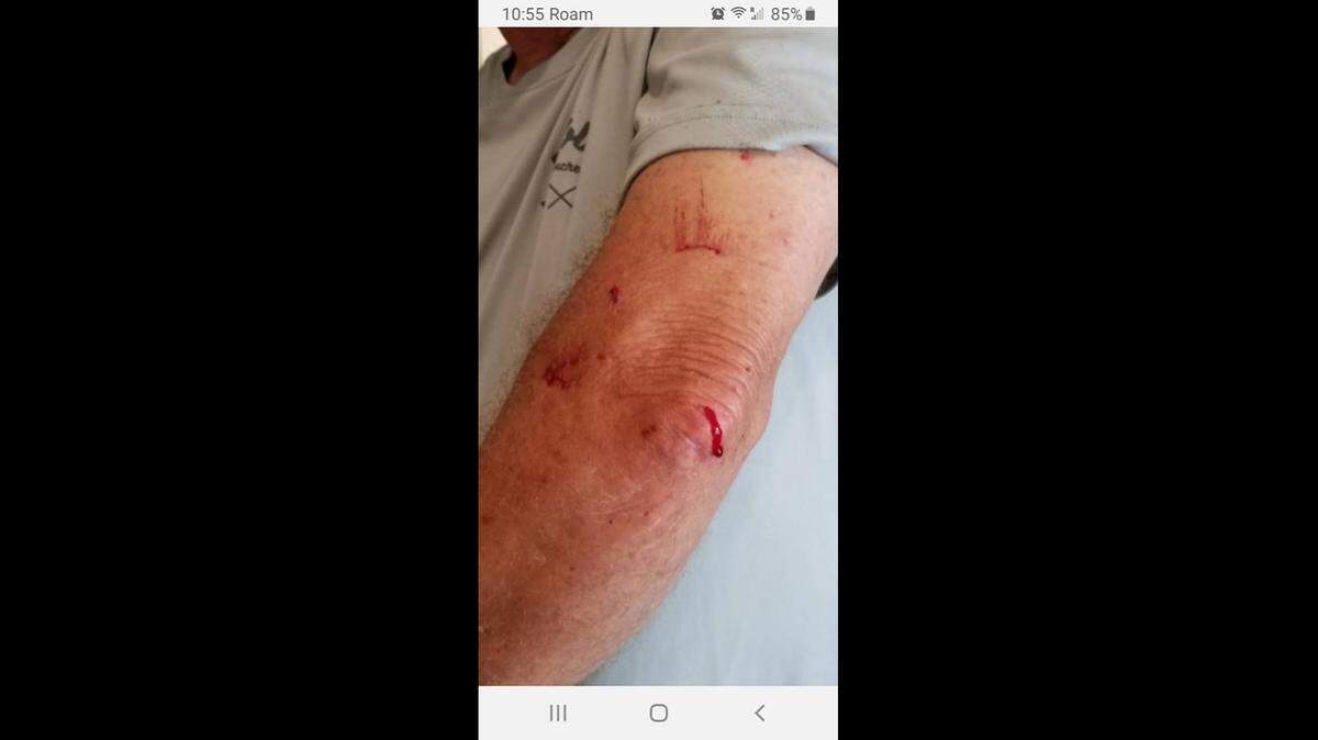 Robby Armstrong of Sarasota posted this picture of a wound to his arm after a squirrel bit him on March 17, 2019.