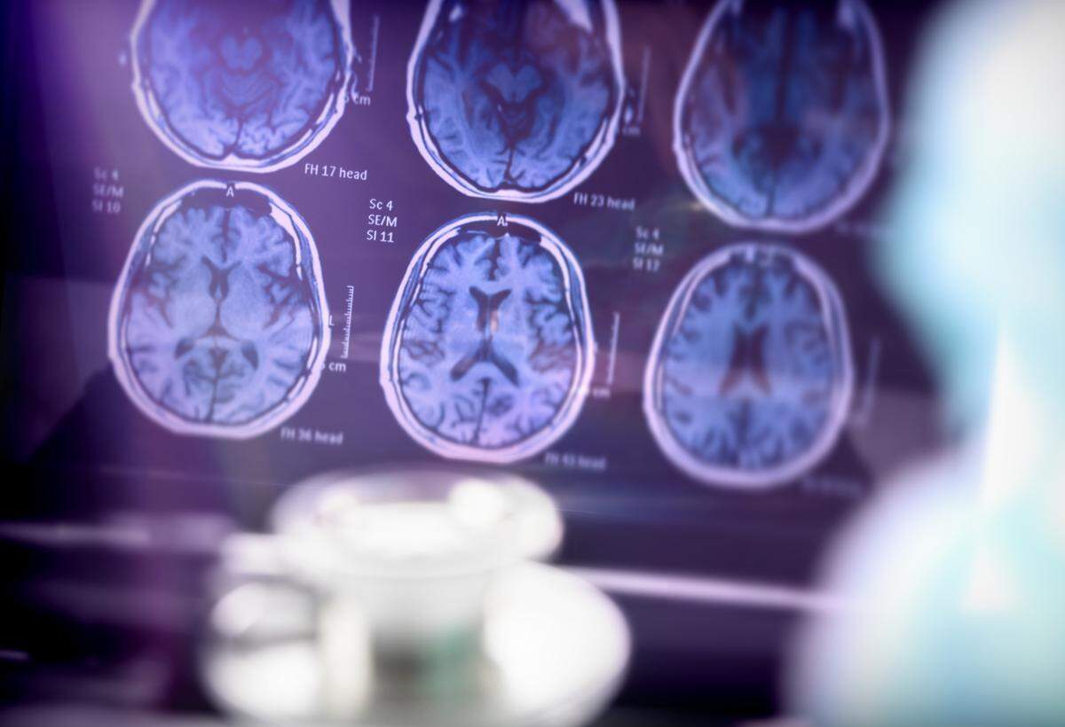 Análisis científico de la enfermedad de Alzheimer en el hospital, imagen conceptual