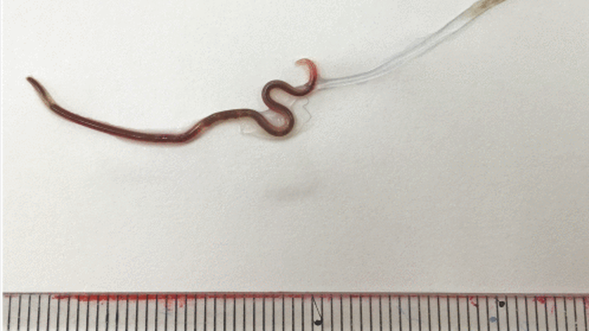 The worm body of Pseudoterranova azarasi molting its outer cuticle. It was found in the tonsil of a 25-year-old woman in Japan after she complained of throat pain.