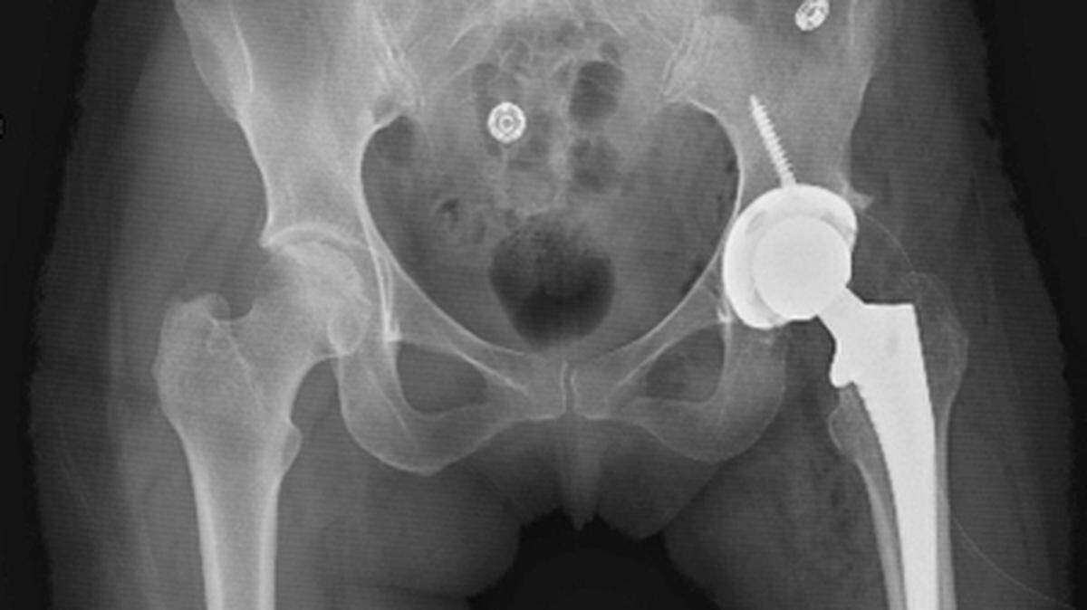 A hip fracture may require hip-replacement surgery for the best outcome, particularly in older patients.