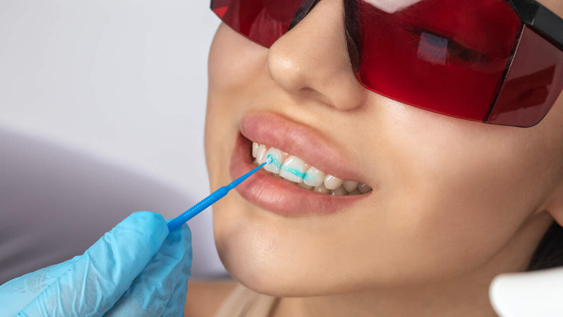 Scientists developed a gel that could help rebuild tooth enamel the way your body first did. Here’s how