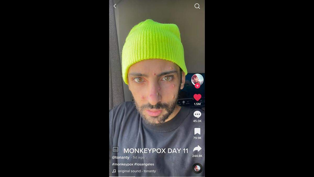 In this photo, TikTok user @tonanty shares what his monkeypox infection looks like in a video posted to the social media platform.