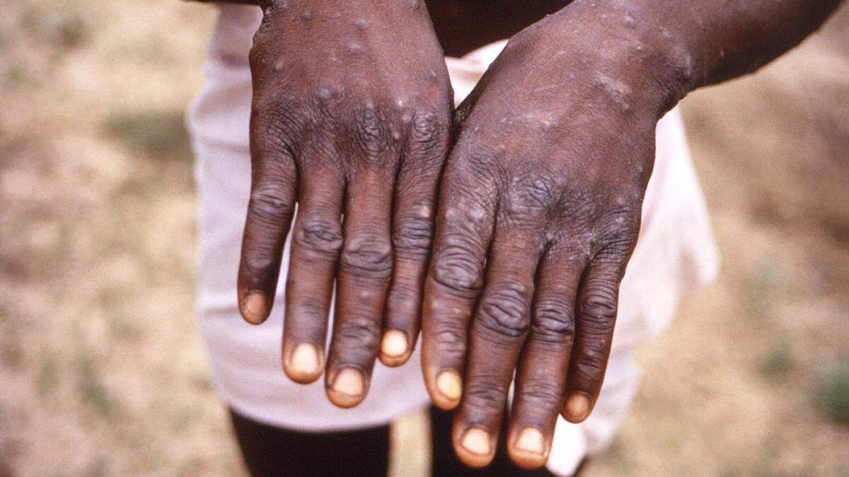 This 1997 image provided by the CDC during an investigation into an outbreak of monkeypox, which took place in the Democratic Republic of the Congo (DRC), and shows the hands of a monkeypox case patient, who was displaying the appearance of the characteristic rash during its recuperative stage.