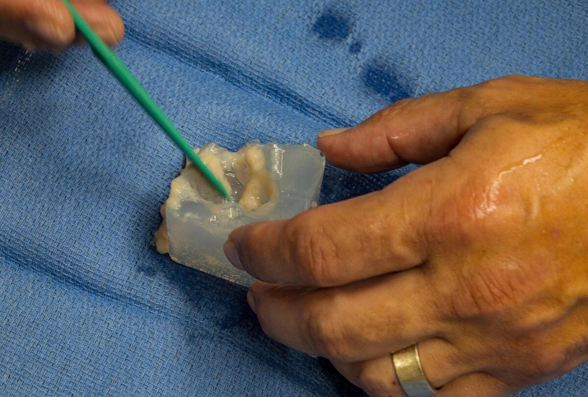 Dr. Omar Llaguna, specialist in surgical oncology, removes a liquid that resulted from the ablation of a mock liver tumor during a histotripsy procedure, performed with a Histosonics, medical device, been tested at the Memorial Hospital West, in Pembroke Pines, on Thursday June 12, 2025.