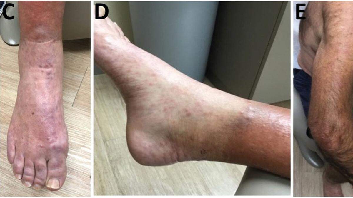 Leprosy, also called Hansen’s disease, in a 54-year-old man in Central Florida in 2022.