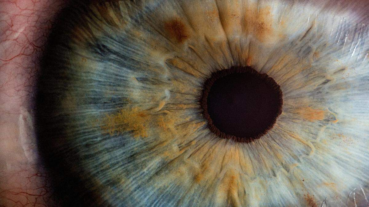 A Beijing woman’s persistent eye irritation was caused by a parasitic worm, doctors said.