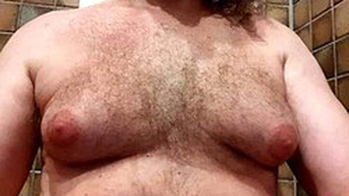 dult male with significant gynecomastia.