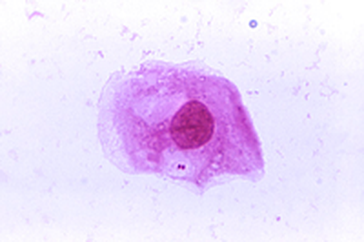 A photomicrograph of the bacteria “Neisseria meningitidis” recovered from the urethra of an asymptomatic male and magnified. The bacteria causes meningococcal disease.