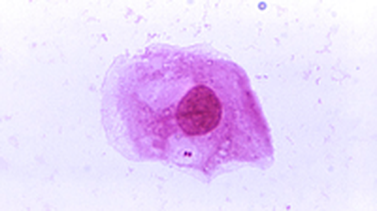 A photomicrograph of the bacteria “Neisseria meningitidis” recovered from the urethra of an asymptomatic male and magnified. The bacteria causes meningococcal disease, a serious disease that is spiking in Florida, state health officials say.
