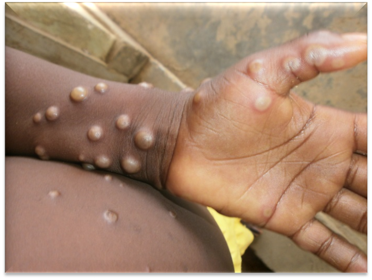 Monkeypox lesions on the skin in this World Health Organization image.