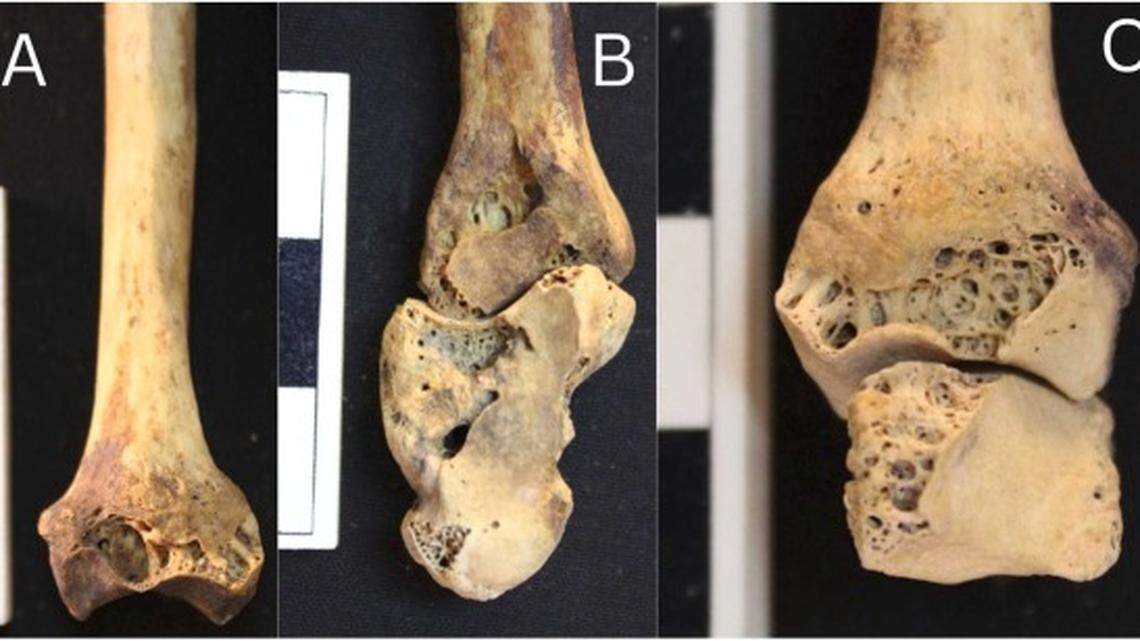A woman who lived more than 3,000 years ago in Egypt had holes in the bones of her joints, suggesting she suffered from a rare autoimmune disease, researchers said.