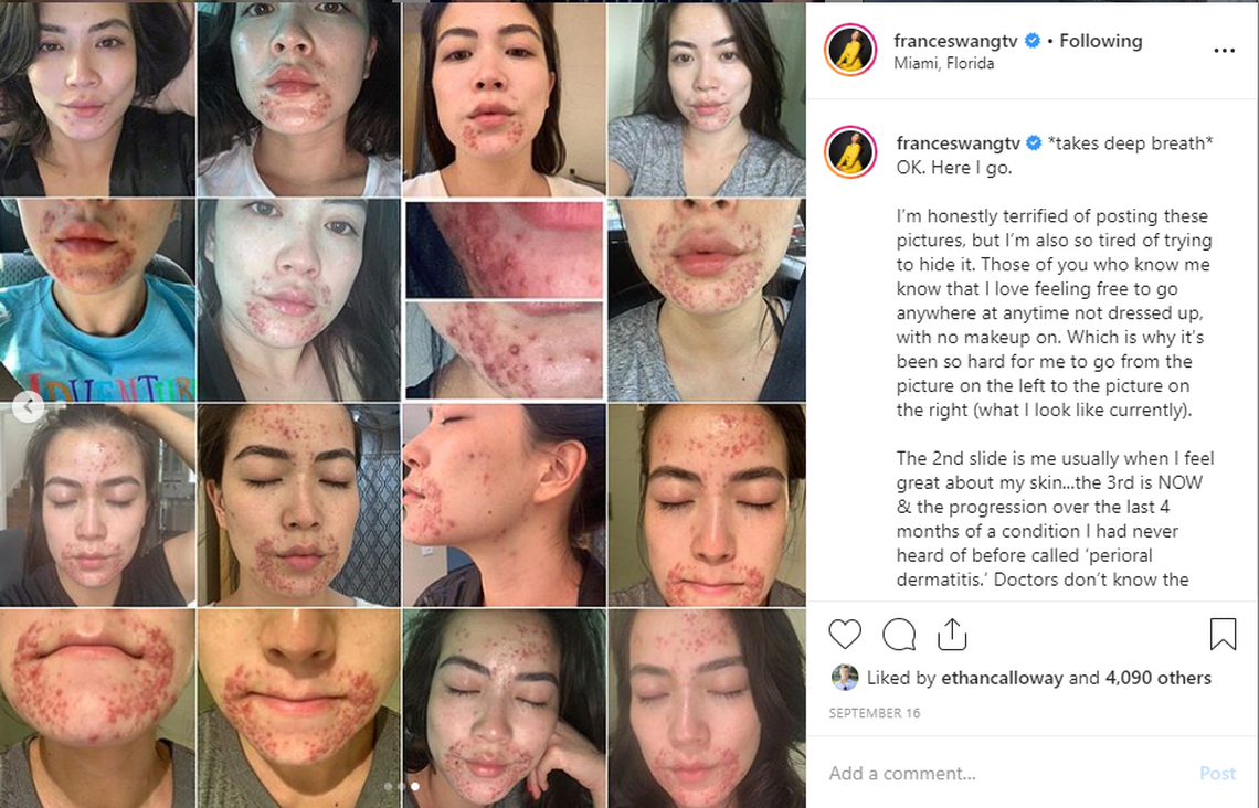 Frances Wang, an anchor at Miami Herald news partner CBS4, was diagnosed with perioral dermatitis.