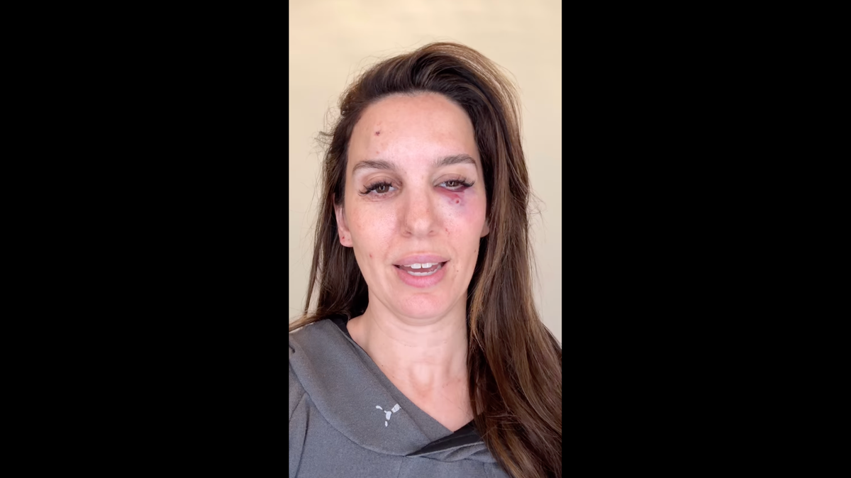 Disney star Christy Carlson Romano said she was shot in the eye.