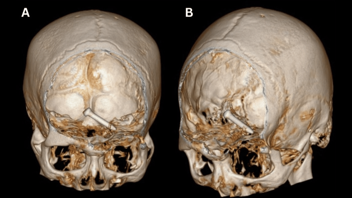 The nail was lodged in the brain tissue behind the worker’s forehead, scans showed.