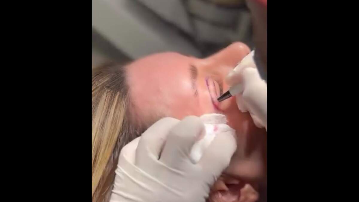 Dr. Carlos Wolf performs eyelid surgery at Miami Plastic Surgery.