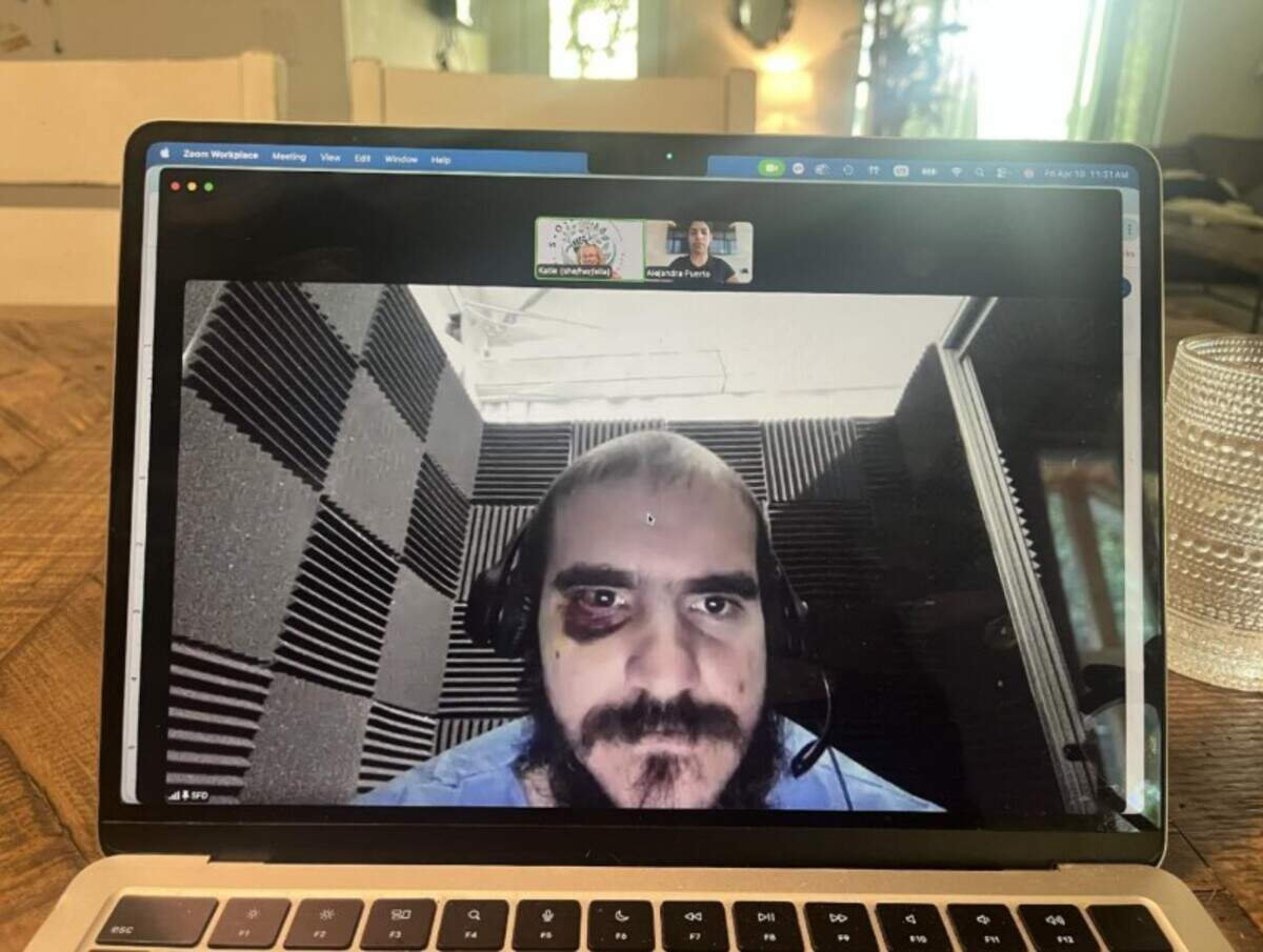 Alligator Alcatraz detainee Raiko Lopez Morffi appeared on an April 10, 2026, video call with his lawyer sporting a black eye from a beating delivered by guards after the immigration detention center’s phones were shut off, causing an uproar, according to a new court filing.
