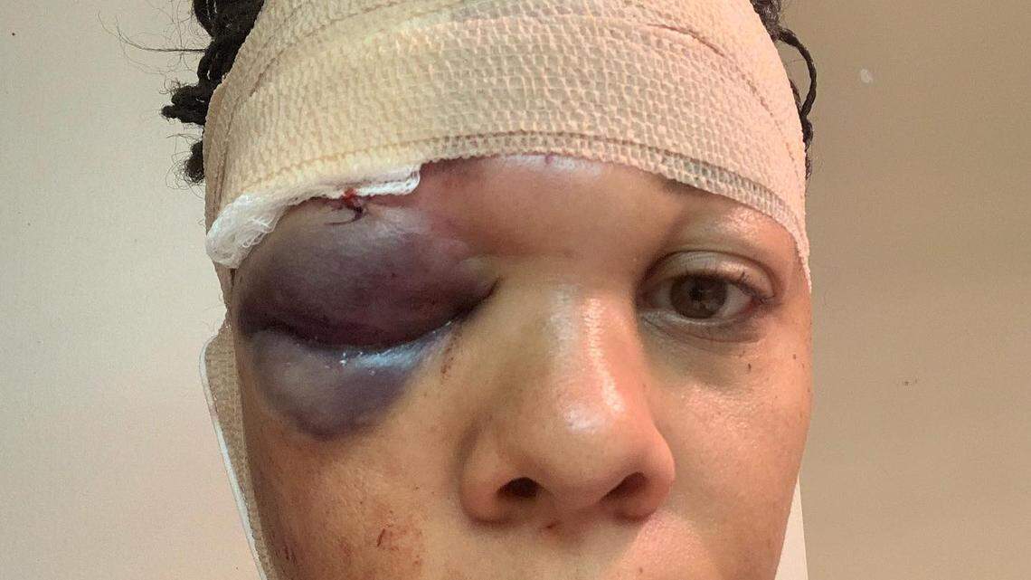 A cop shot a peaceful protester in the face with a rubber bullet. The city cleared him.