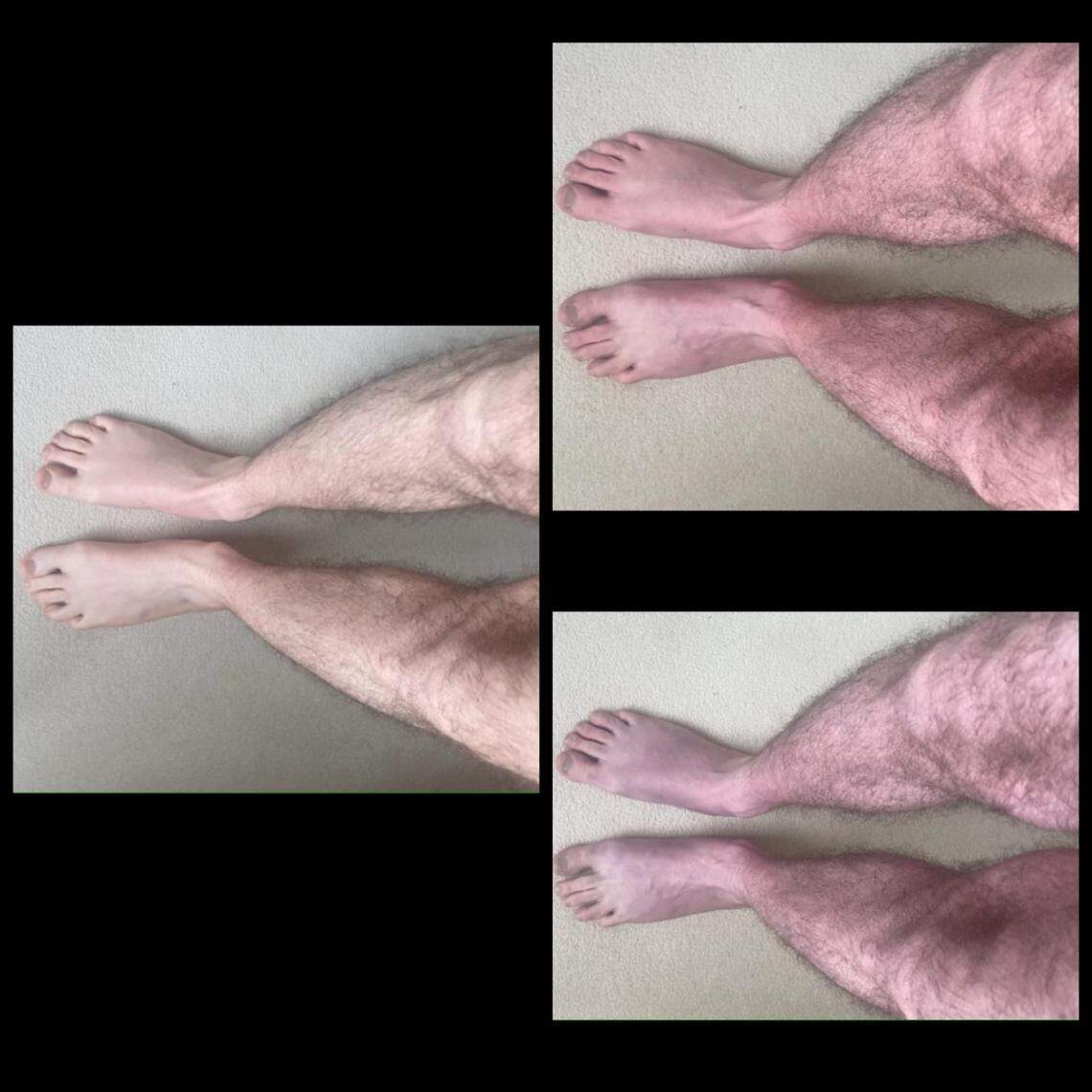 When the man stood for 0 minutes, left, his legs were normal. But when he stood for 2 minutes, top right, or 10 minutes, bottom right, his legs became discolored and uncomfortable.