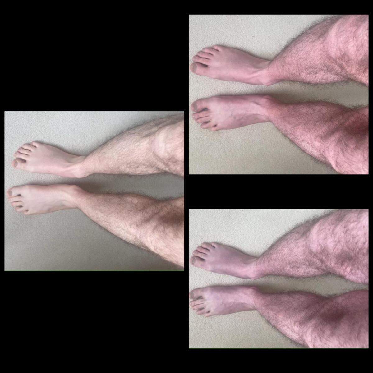 When the man stood for 0 minutes, left, his legs were normal. But when he stood for 2 minutes, top right, or 10 minutes, bottom right, his legs became discolored and uncomfortable.