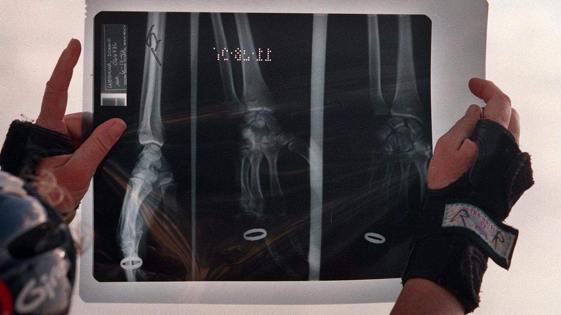 A broken wrist may require surgery to reset and avoid future complications