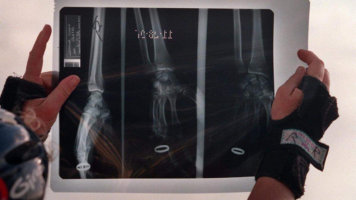 A broken wrist may require surgery to reset it and avoid complications .