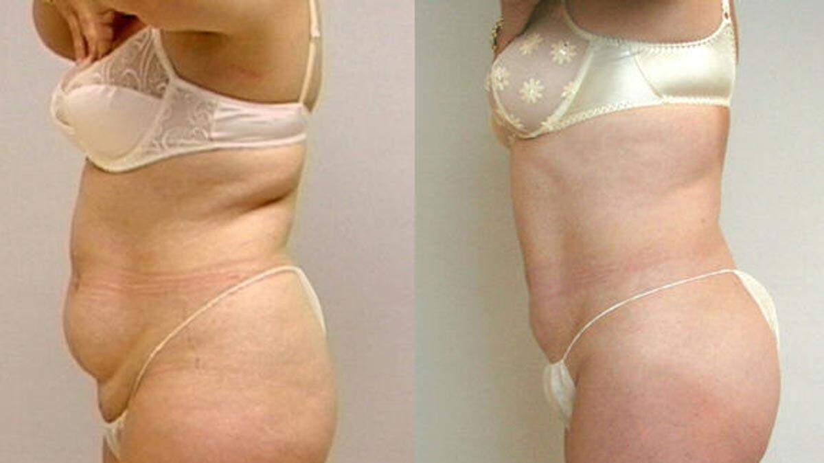 Liposuction
