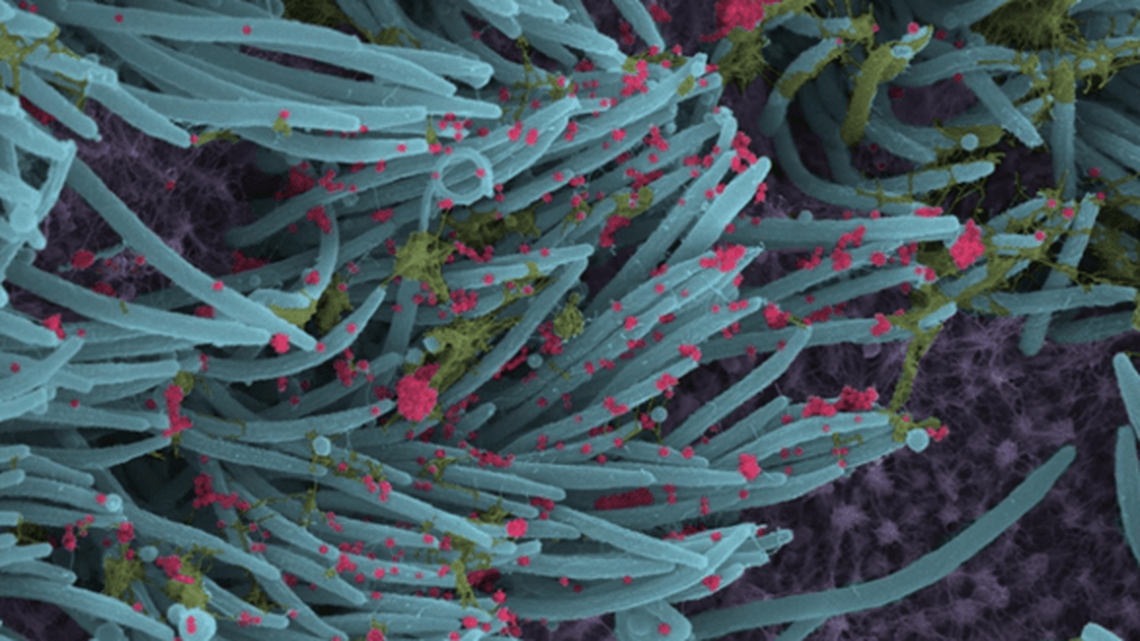 This colorized scanning electron microscope image shows SARS-CoV-2-infected human lung cells (purple) covered in hair-like cilia (blue). Those cilia line the inner surface of the airways and help to clear mucus (yellow-green) containing dust and other debris from the lungs. Emerging from the surface of those infected airway cells are many thousands of coronavirus particles (red).