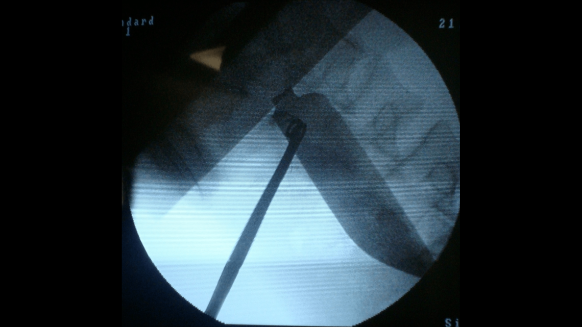 The blade moved from one side of the man’s body to the other without hitting any internal organs, doctors said.