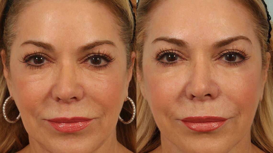 Left, a woman before receiving a Juvederm Voluma injection; right, the same woman after the cosmetic injection.